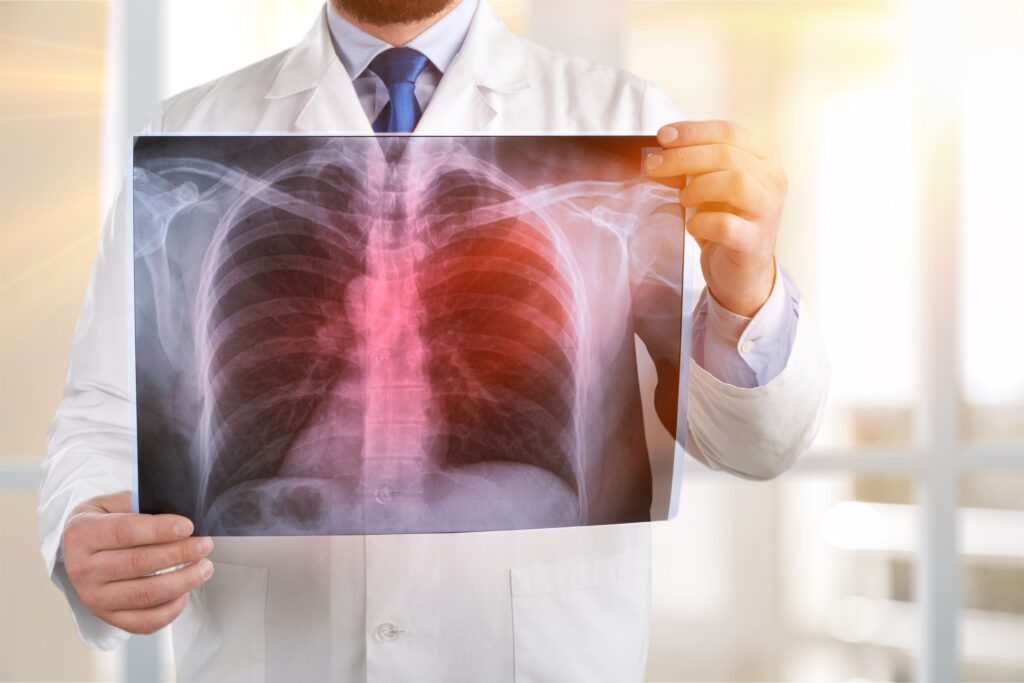 doctor with X-ray of tuberculosis patient